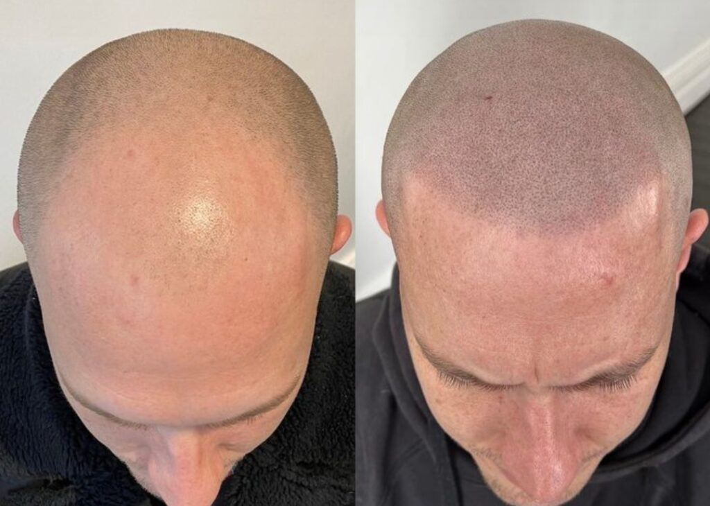 PMU con Proposito Capilar